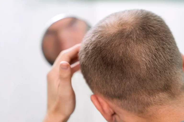 adult male having hair loss