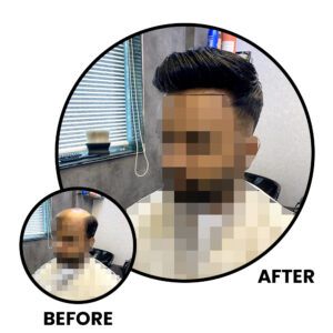 Before and After Non-Surgical Hair Replacement​