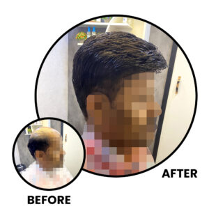 Before and After Non-Surgical Hair Replacement​