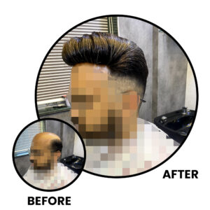 Before and After Non-Surgical Hair Replacement​