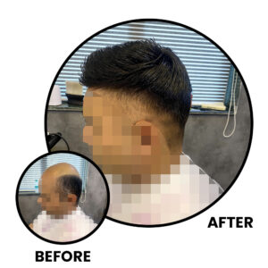 Before and After Non-Surgical Hair Replacement​