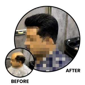 Before and After Non-Surgical Hair Replacement​