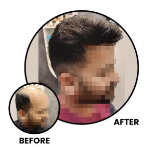 Before and After Non-Surgical Hair Replacement​